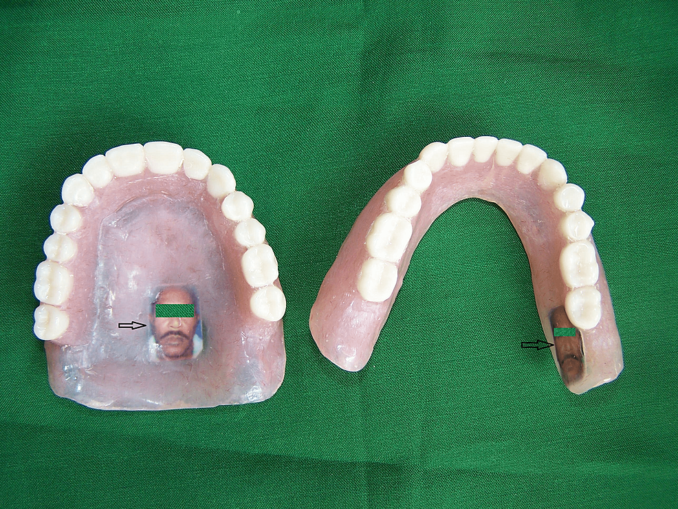 Cureus A Simple DentureMarking Technique for Patients Residing at