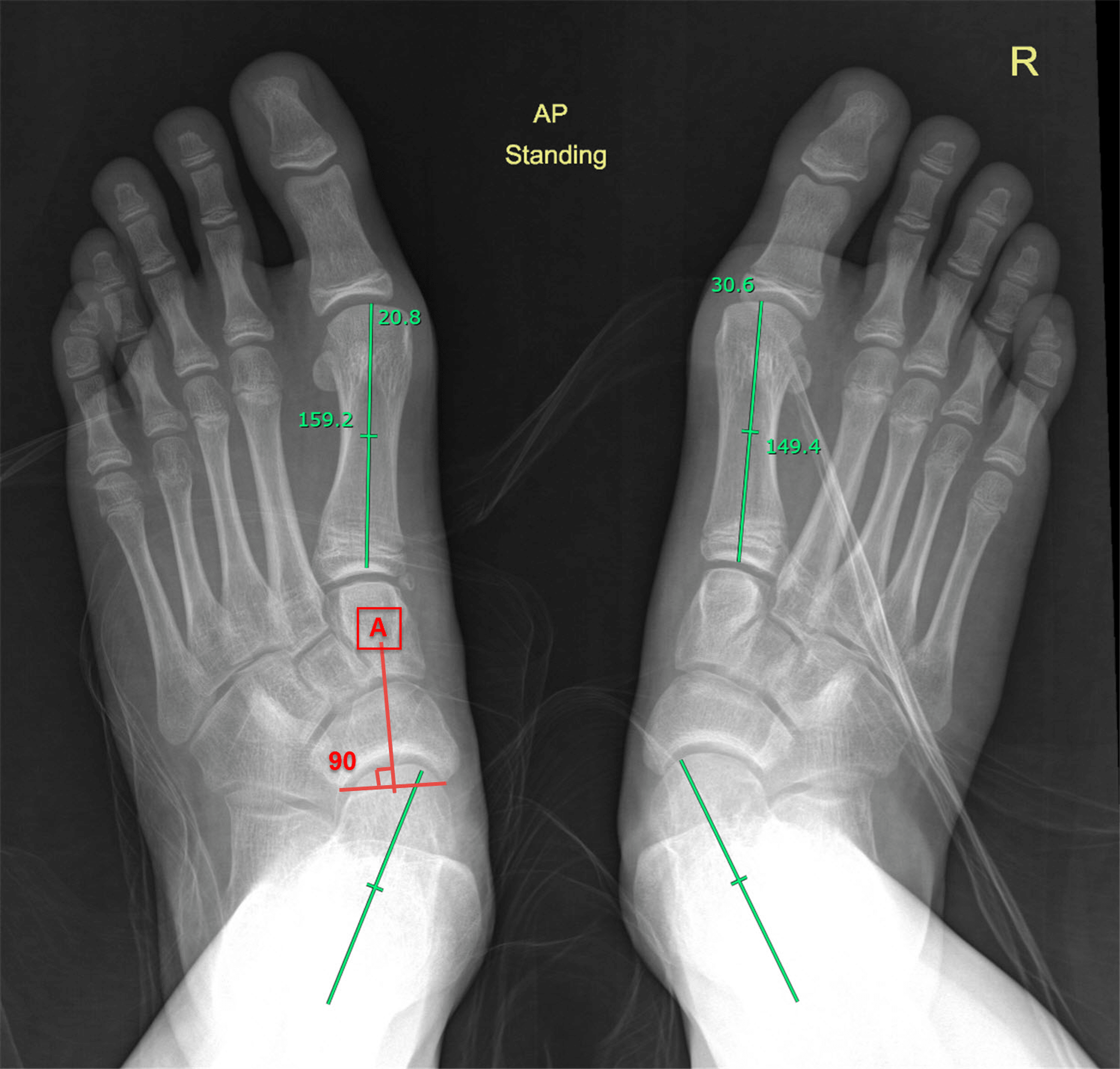 Cureus | Adolescent-Acquired Flatfeet: The Tip of the Iceberg