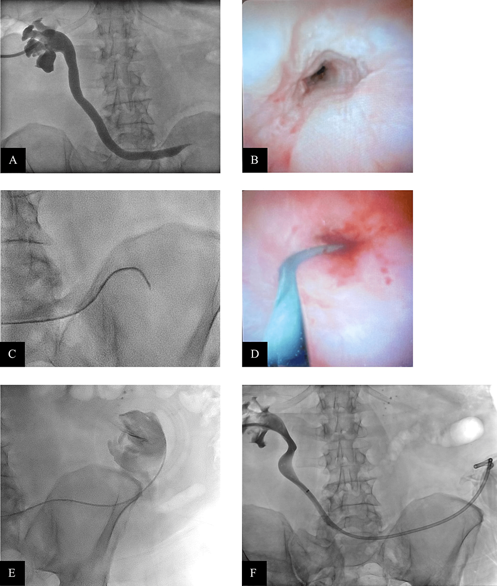 Cureus EndoscopeAssisted Traversal of a Ureteral Stricture From