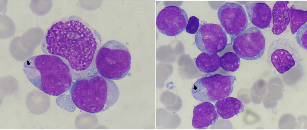 Cureus | Acute Myeloid Leukemia Revealed by a Palatal Necrosis: A Rare