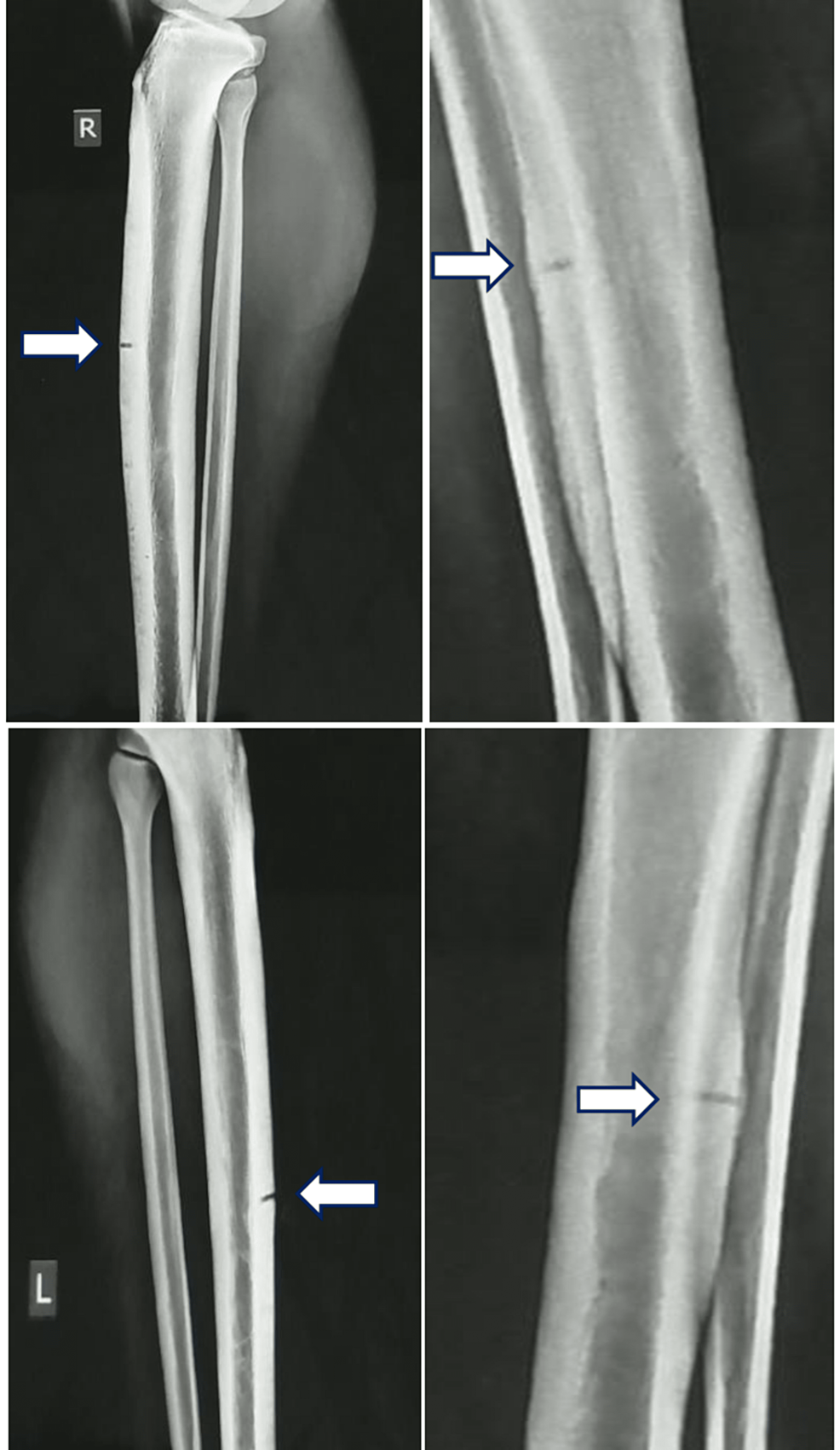 Postoperative X-rays of tibial fracture. Shows the use of standard... |  Download Scientific Diagram