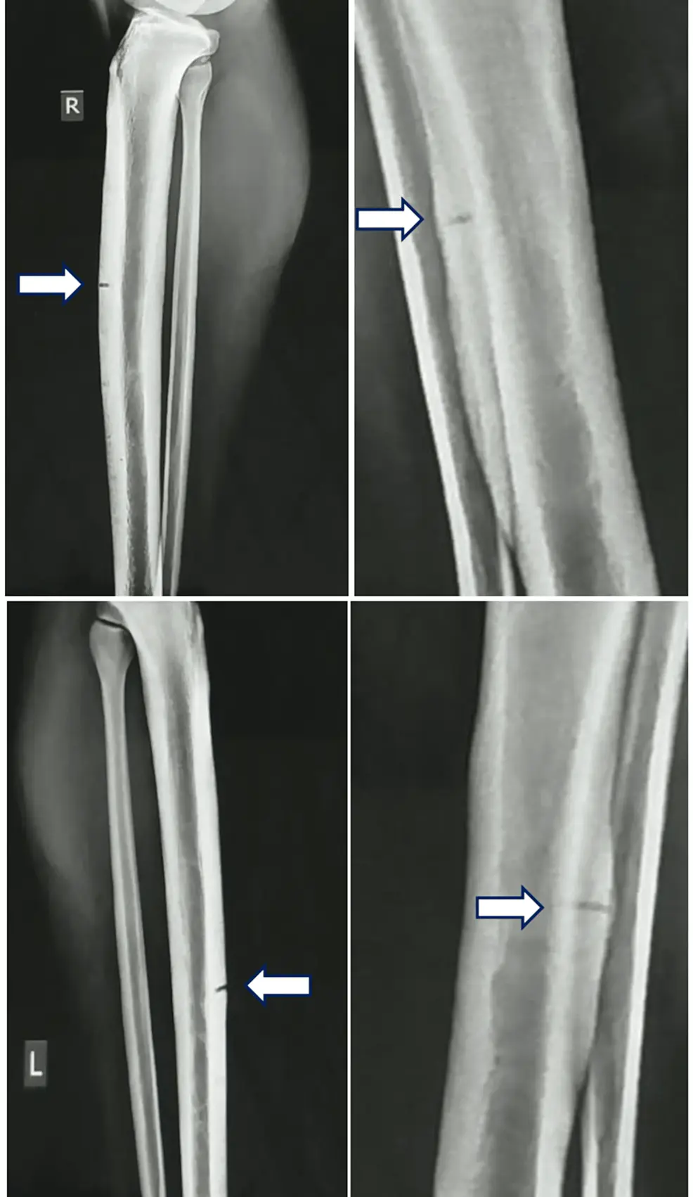Gemeenten kofferbak karakter Cureus | Intramedullary Nailing of Concurrent Bilateral Tibial Stress  Fractures Followed by Unilateral Tension Plating for a Nonunion in a  Vitamin D-Deficient Elite Football Player | Article