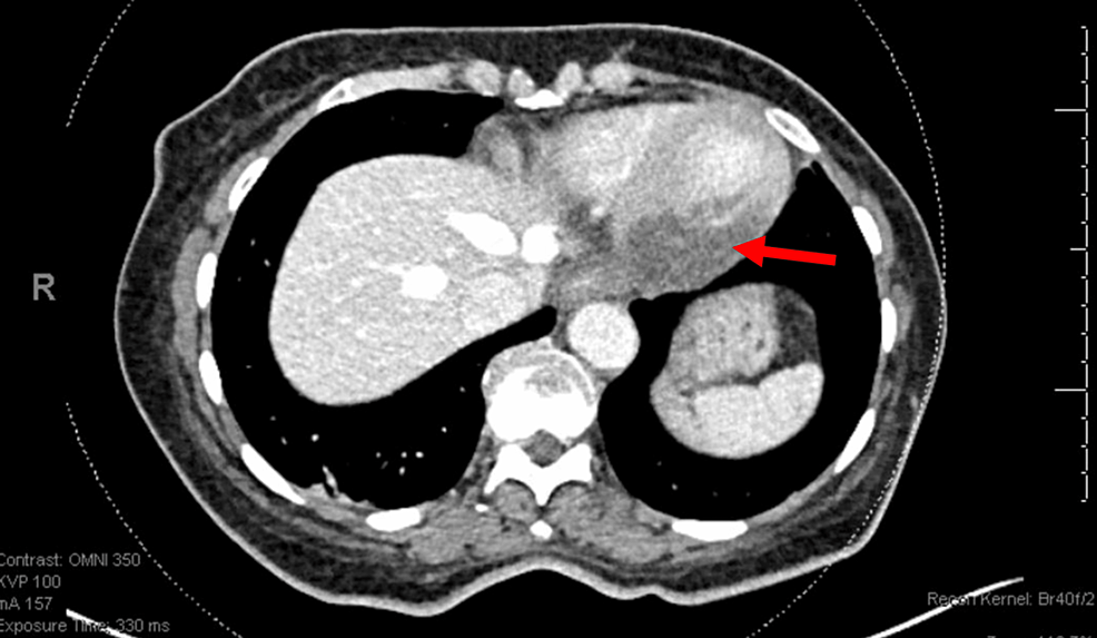 Abdominal and Pelvic Computed Tomography for the Diagnosis of ST