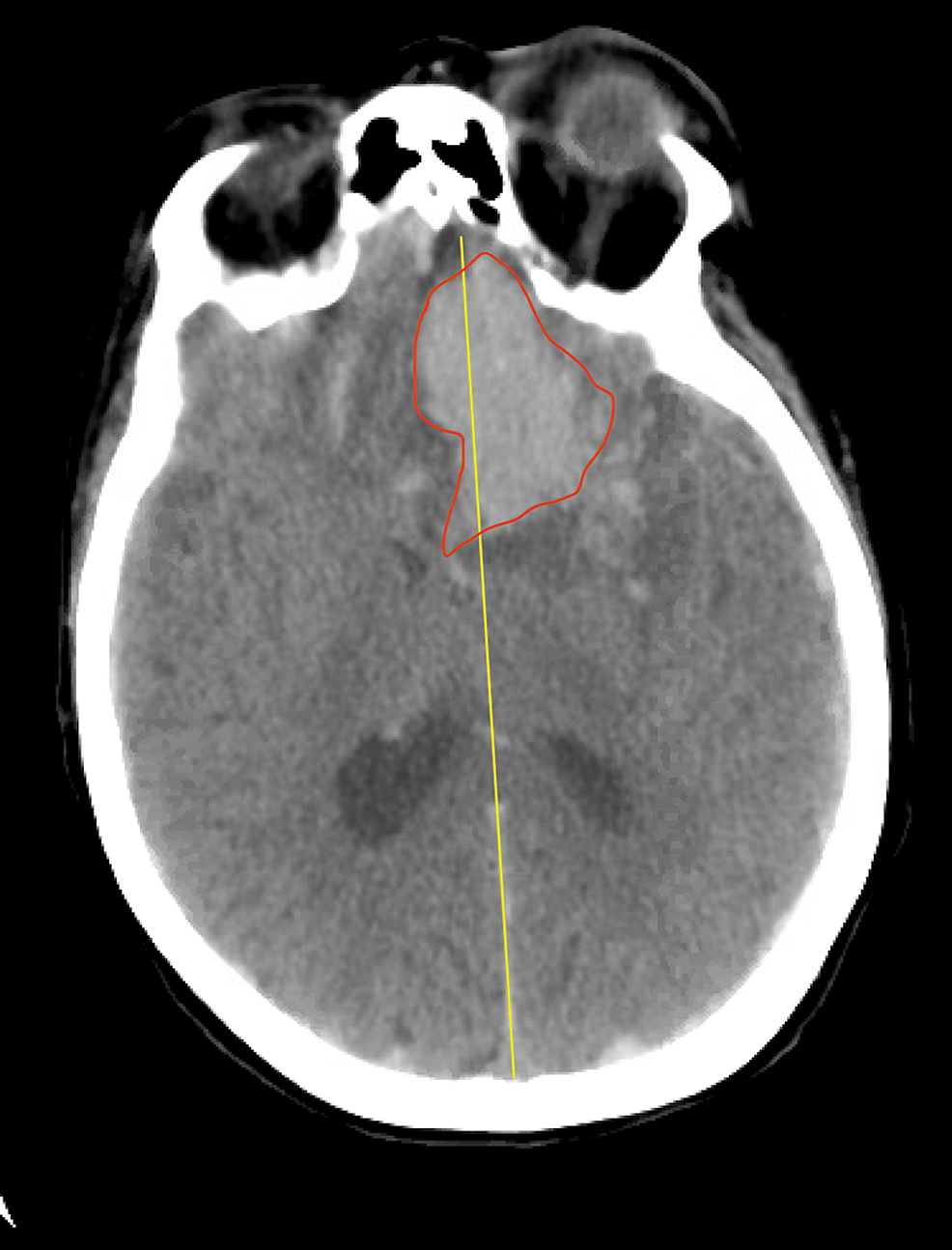 Patient's-non-contrast-CT-scan-