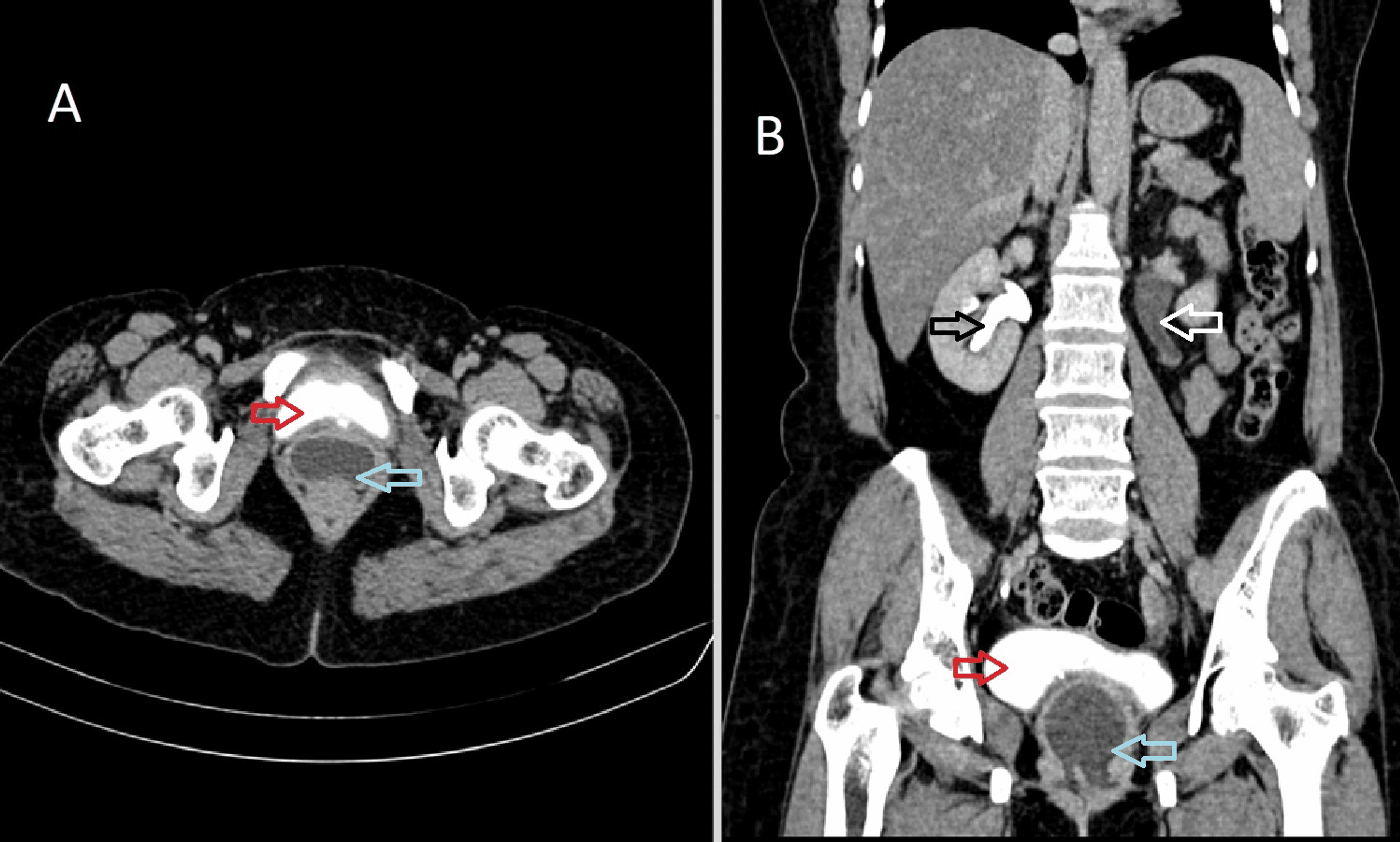 Cureus Ureterovaginal Fistula Post Vaginal Hysterectomy