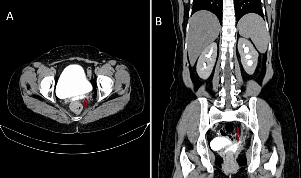 Cureus Ureterovaginal Fistula Post Vaginal Hysterectomy