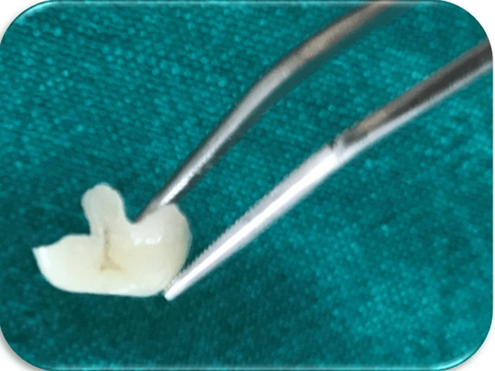 Ceramic Onlay A Case Report Cureus