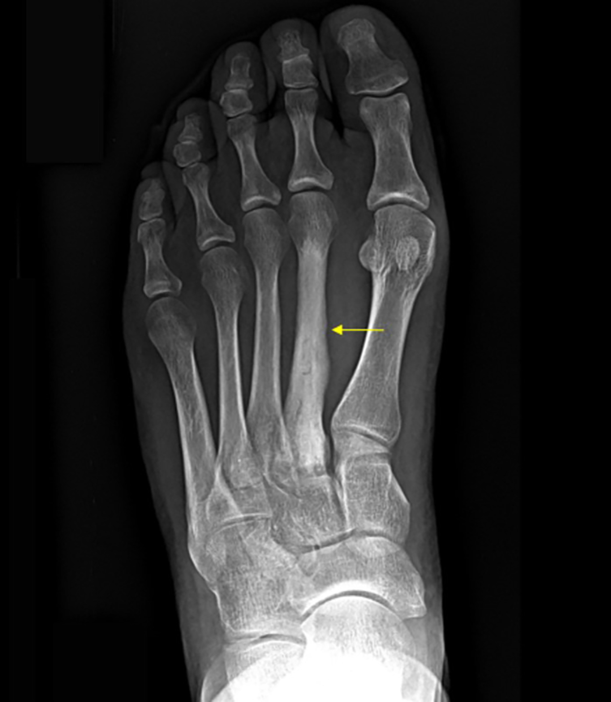 hairline fracture in foot