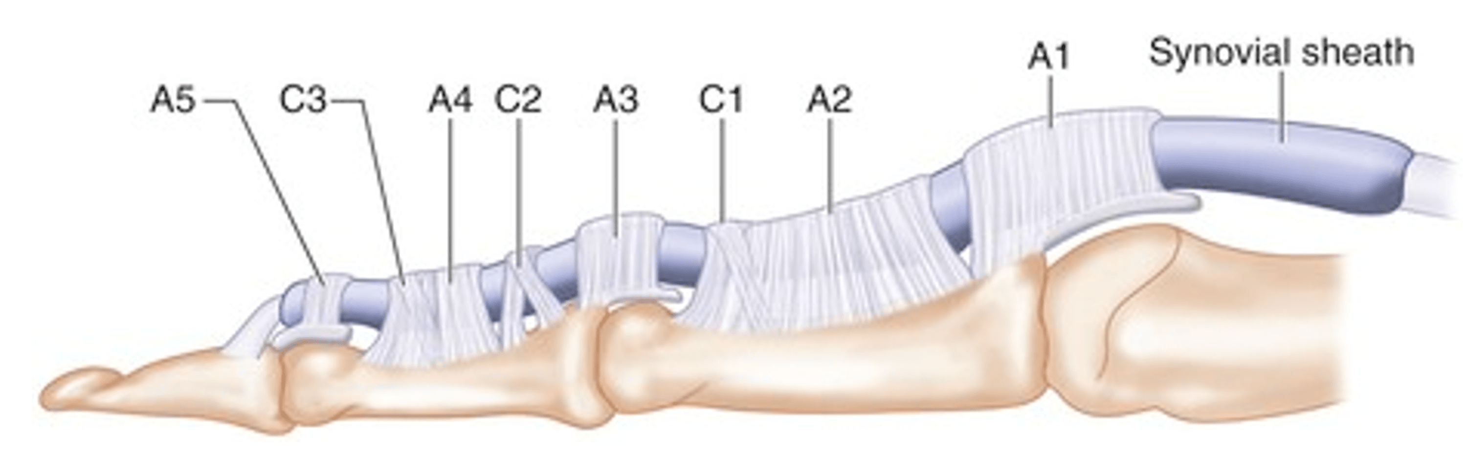 Isolated Flexor Digitorum Profundus Injuries in Flexor Zone II of the