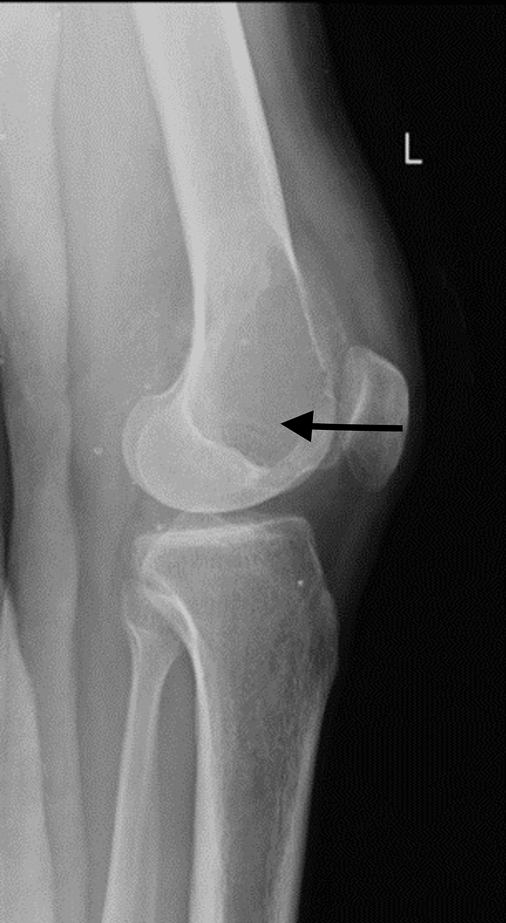 :-Plain-radiograph-of-knee,-lateral-view-shows-lytic-lesion-over-lateral-femoral-condyle