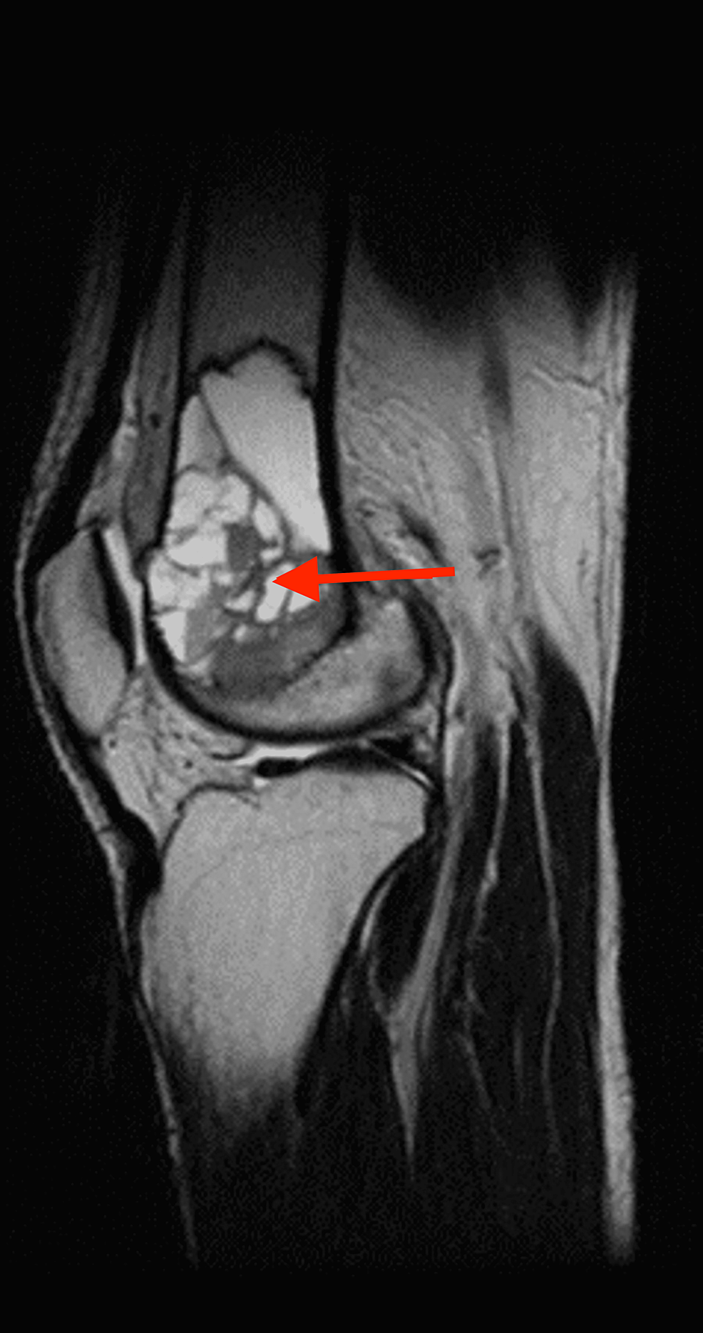 MRI-of-left-knee-showing-well-defined-multiloculated-expansile-altered-signal-intensity-mass-lesion-at-the-distal-end-of-femur-appearing-hyperintense-on-T2WI,-variable-intensity-on-T1WI,-showing-fluid--fluid-levels-within-the-locules-with-areas-of-blooming-on-T2-and-hyperintensities-in-T1WI-suggestive-of--heamorrhagic-components.---