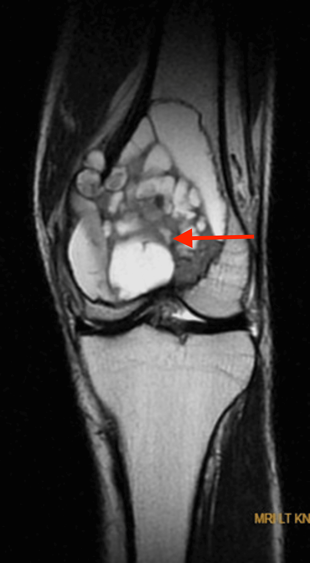 MRI-of-left-knee-showing-well-defined-multiloculated-expansile-altered-signal-intensity-mass-lesion-at-the-distal-end-of-femur-appearing-hyperintense-on-T2WI,-variable-intensity-on-T1WI,-showing-fluid--fluid-levels-within-the-locules-with-areas-of-blooming-on-T2-and-hyperintensities-in-T1WI-suggestive-of--heamorrhagic-components.