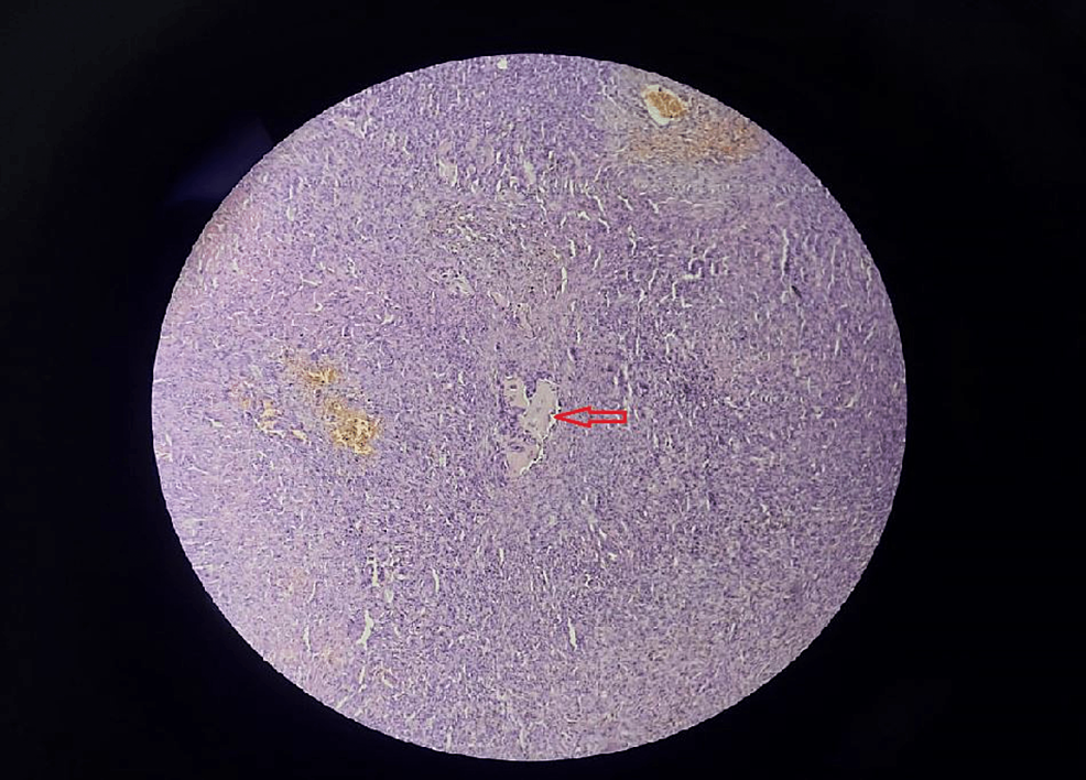 Biopsy-material-demonstrated-features-of-aneurysmal-bone-cyst-with-bland-stromal-cells-with-osteoclast-like-giant-cells-(H&E,-x125)