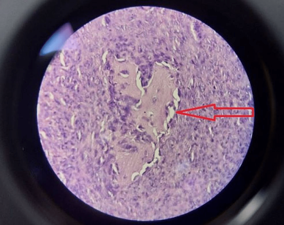 High-power-examination-shows-features-of-aneurysmal-bone-cyst-with-bland-stromal-cells-with-osteoclast-like-giant-cells-(H&E,-x250).