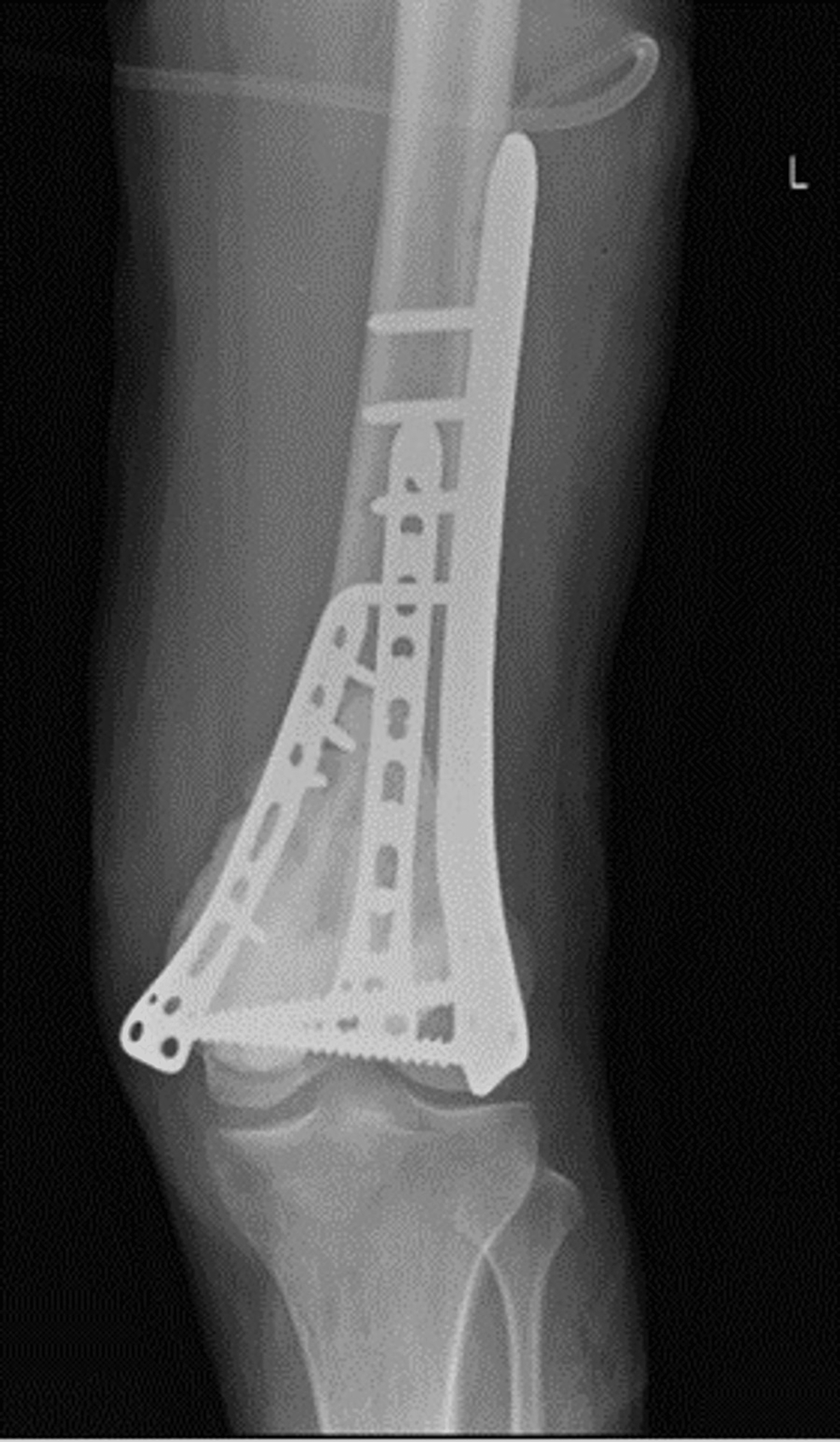 Shows-postoperative-plain-radiograph-anteroposterior-view-of-left-knee-with-3-plate-fixation.