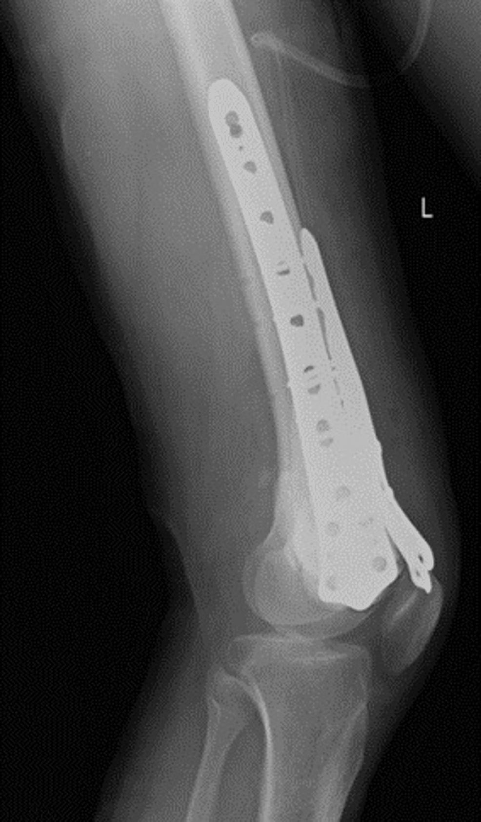 Shows-postoperative-plain-radiograph-lateral-view-of-left-knee-with-3-plate-fixation.