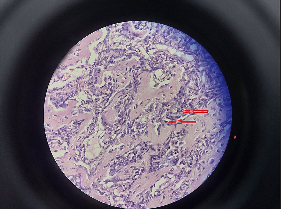 Shows-a-high-grade-spindle-cell-osteosarcoma-composed-of-masses-of-fibrosarcoma-like,-malignant-spindle-cells.(H&E,-x250)