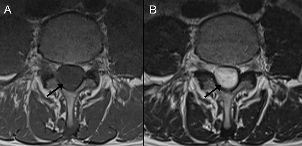 Lumbar-spine-magnetic-resonance-imaging,-axial-views-at-the-level-of-L4.