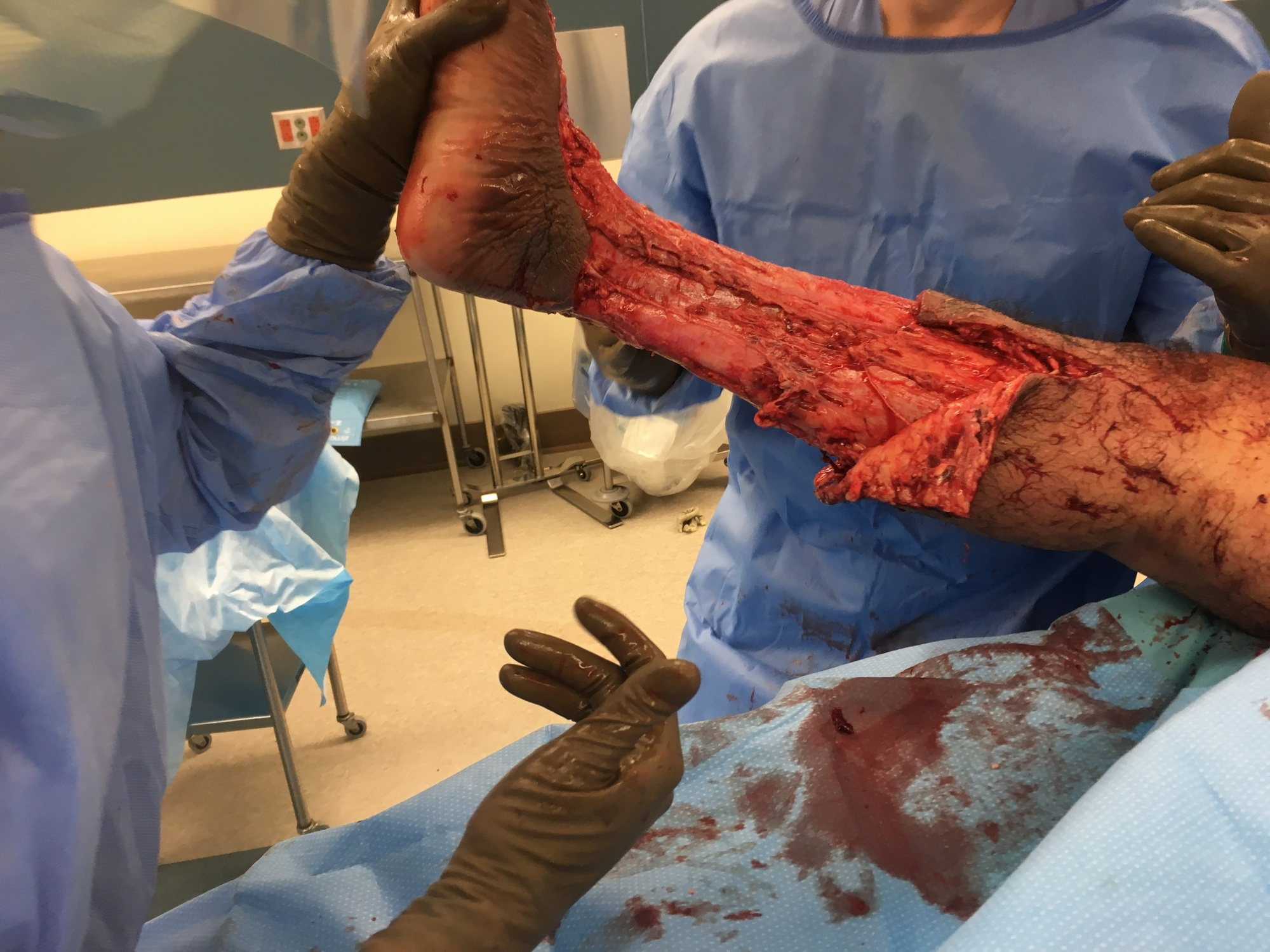 Cureus Utilizing Negative Pressure Wound Therapy With Instillation And Dwell Time For Extensive Necrotizing Fasciitis Of The Lower Extremity A Case Report