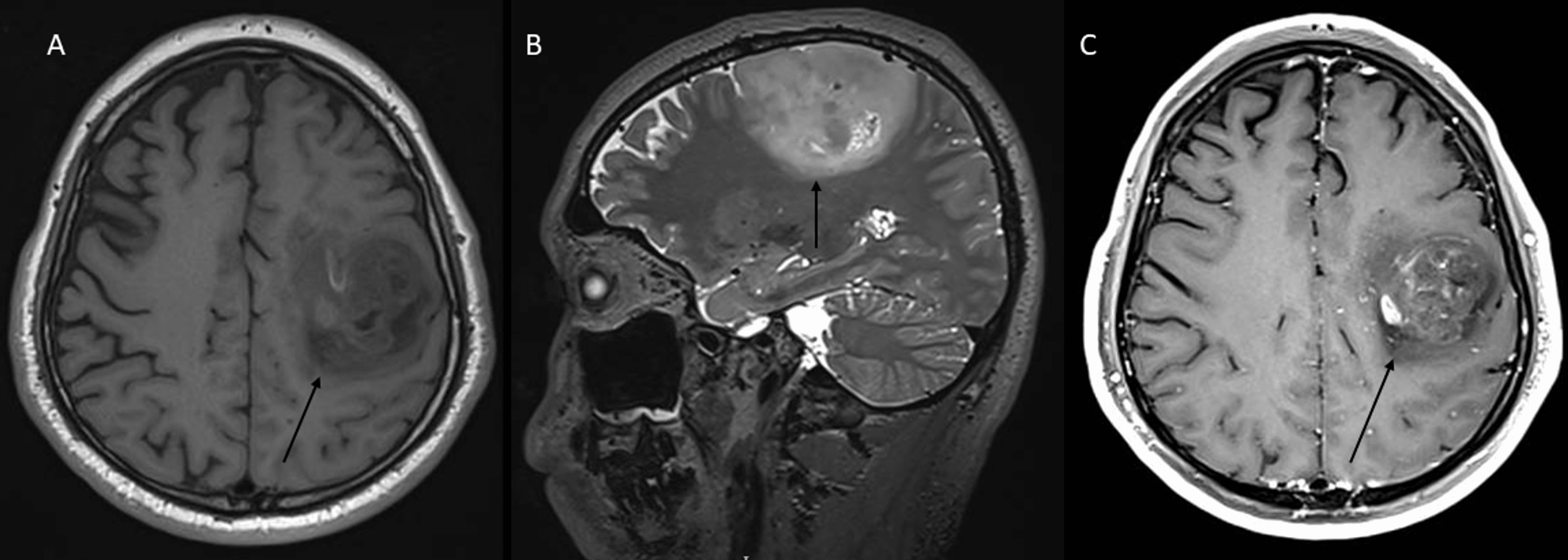 Cureus | A Patient With Epilepsy, Ganglioglioma, And Oligodendroglioma