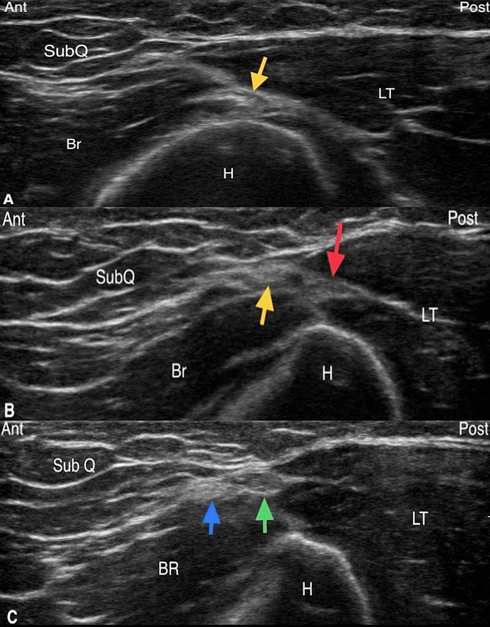 Novel Ultrasound-Guided Radiofrequency Ablation of the Epicondylar Branch  of the Posterior Cutaneous Nerve of the Forearm for Recalcitrant Lateral  Epicondylosis | Cureus