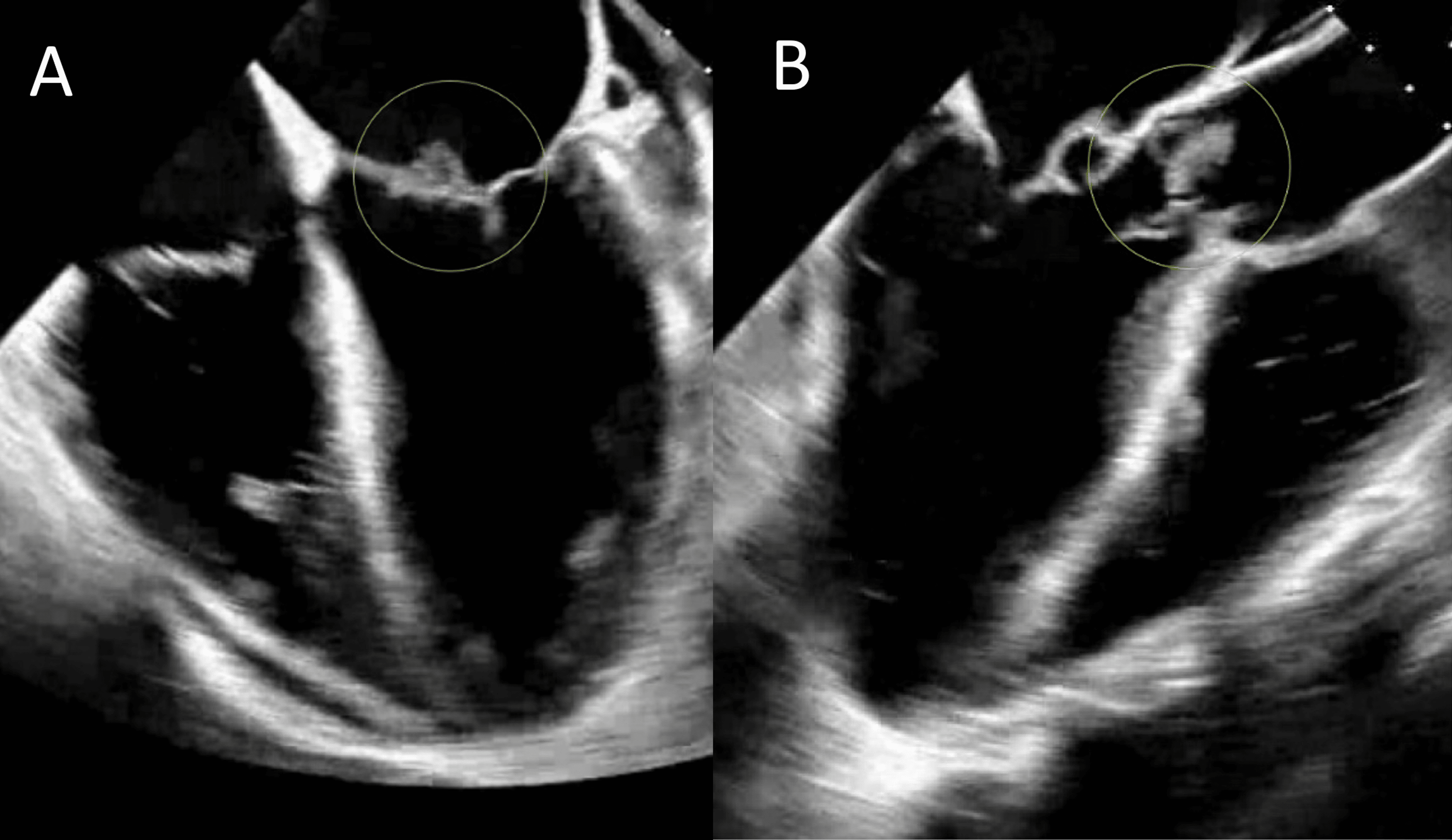 Cureus A Case of LeftSided Infective Endocarditis of Multiple Native