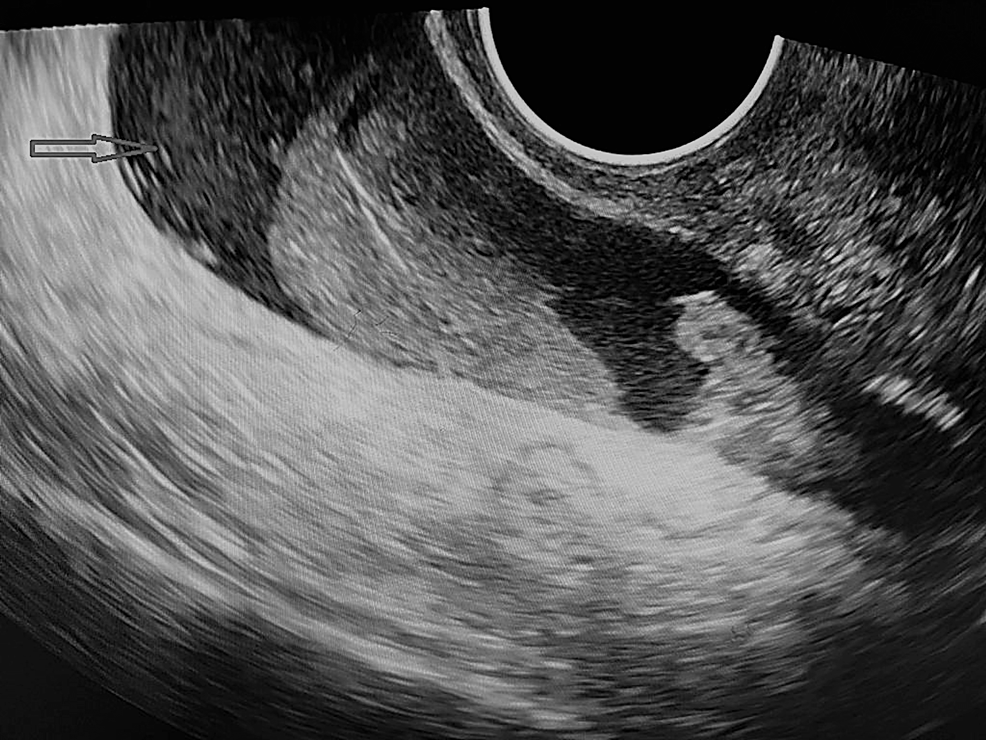 Thirty-seven-year-old female with ruptured ectopic pregnancy.