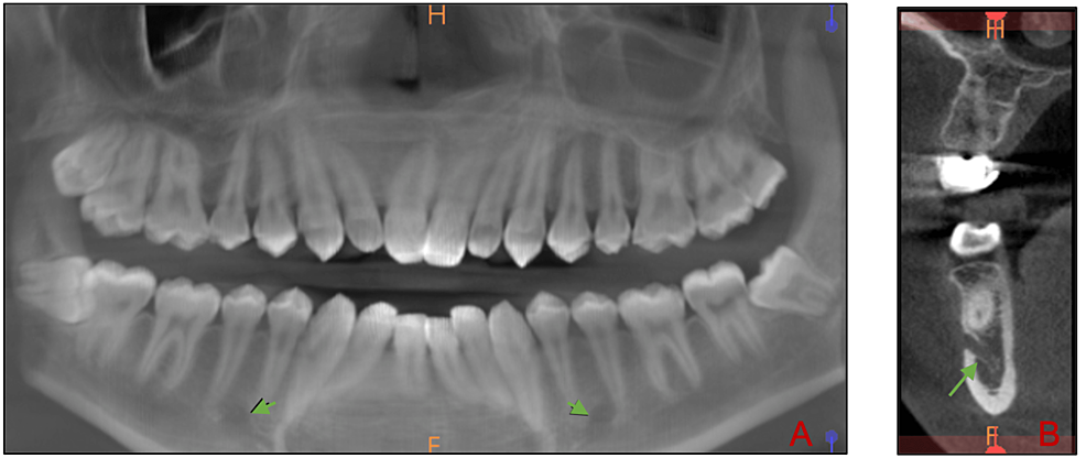 Inferior alveolar nerve, Radiology Reference Article