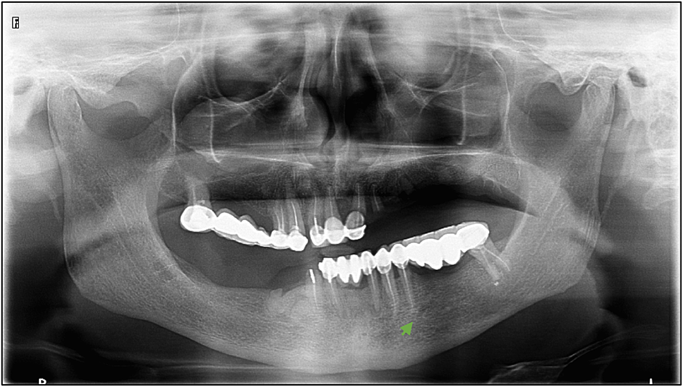 Cureus Mental Nerve Anterior Loop Detection In Panoramic And Cone