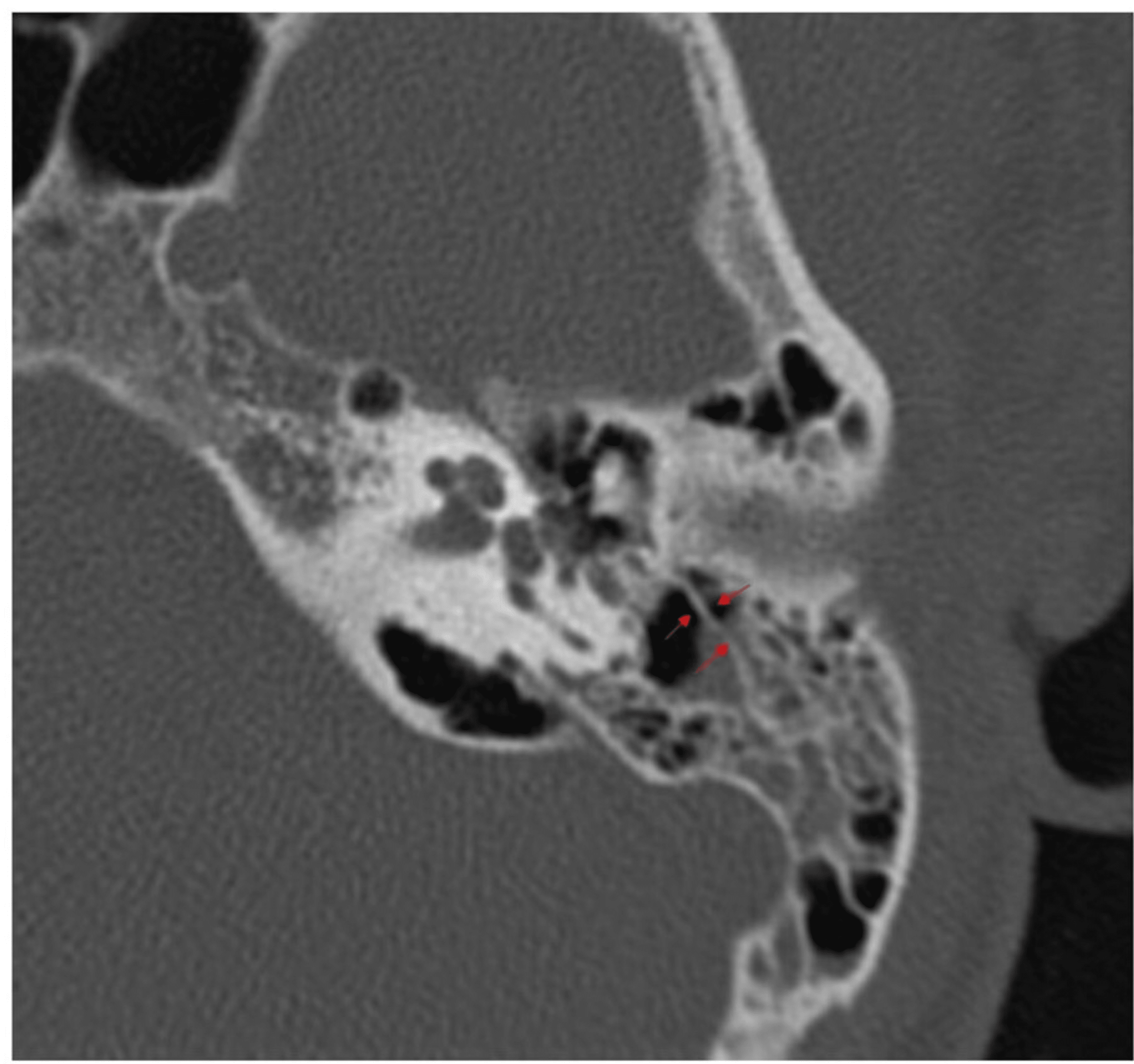 Cureus Clinical Significance of Körner’s Septum in Relation to