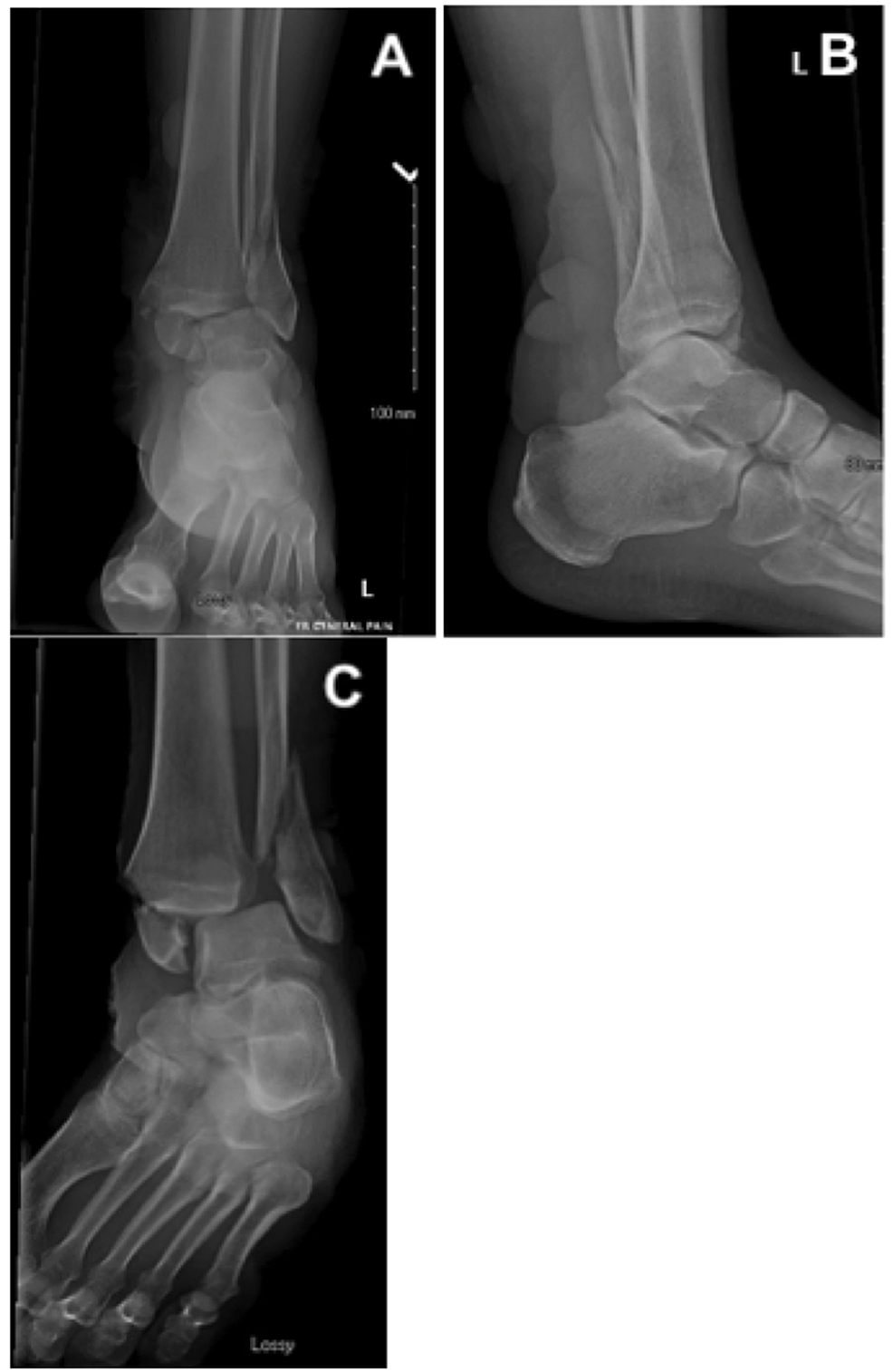 Cureus A Novel Method for Fracture Blister Management Using