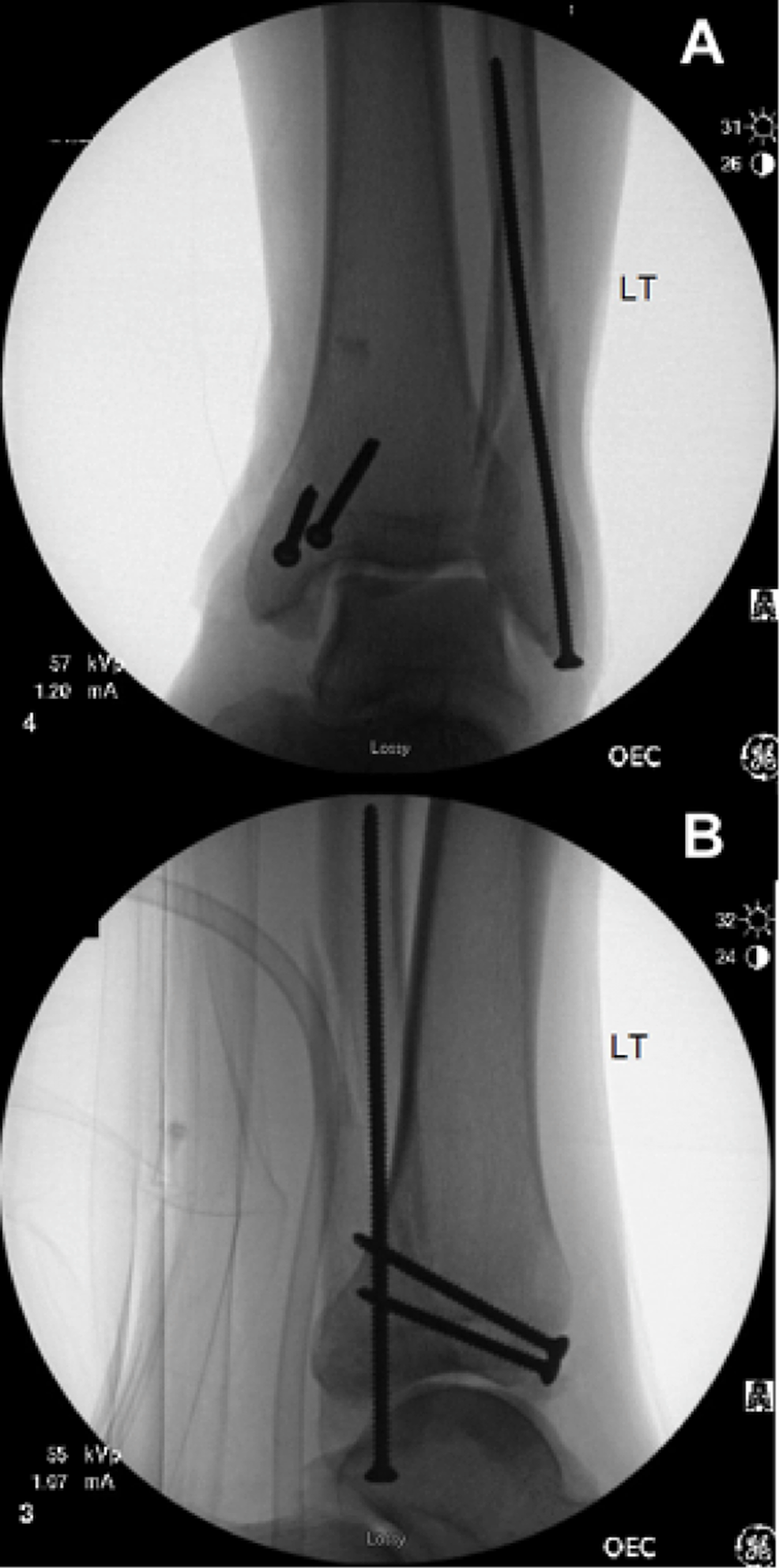 Cureus A Novel Method for Fracture Blister Management Using