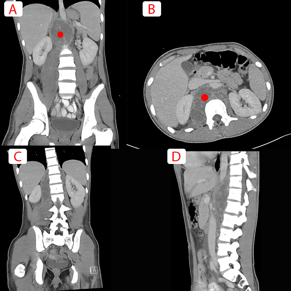 (A)-Axial-and-(B)-sagittal-view-of-a-CT-scan-of-abdomen-an-pelvis-showing-a-large-thick-multiseptated-retroperitoneal-abscess-(red-circle-localizing-the-retroperitoneal-abscess)-extending-to-the-right-iliopsoas-and-iliacus-muscle-with-associated-right-pelvis-and-rectovesical-pouch-free-fluid,-and-a-few-hypodense,-necrotic-enlarged-retroperitoneal-lymphadenopathy.-No-underlying-bony-destruction-to-suggest-discitis.-C-and-D-are-further-images-showing-no-vertebral-involvement-at-this-stage.