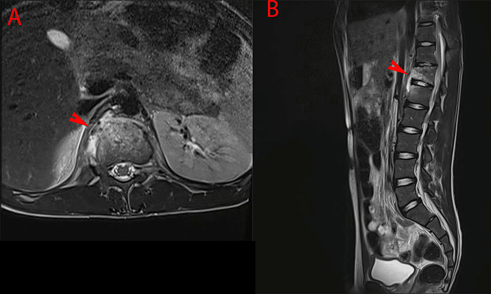 T2-weighted-images-of-thoracolumbar-MRI-post-drainage-procedure-shows-subligamentous-extension-at-the-level-of-T12-and-L1-vertebra-leading-to-osteomyelitis-of-those-vertebrae.-T12-vertebra-showing-mild-vertebra-height-reduction-with-an-abnormal-signal-intensity-high-in-T2,-similar-findings-in-the-superior-anterior-end-of-L1.-No-definite-extension-to-the-neural-foramina-or-the-central-canal-posteriorly.-Red-arrowheads-point-to-vertebral-osteomyelitis.