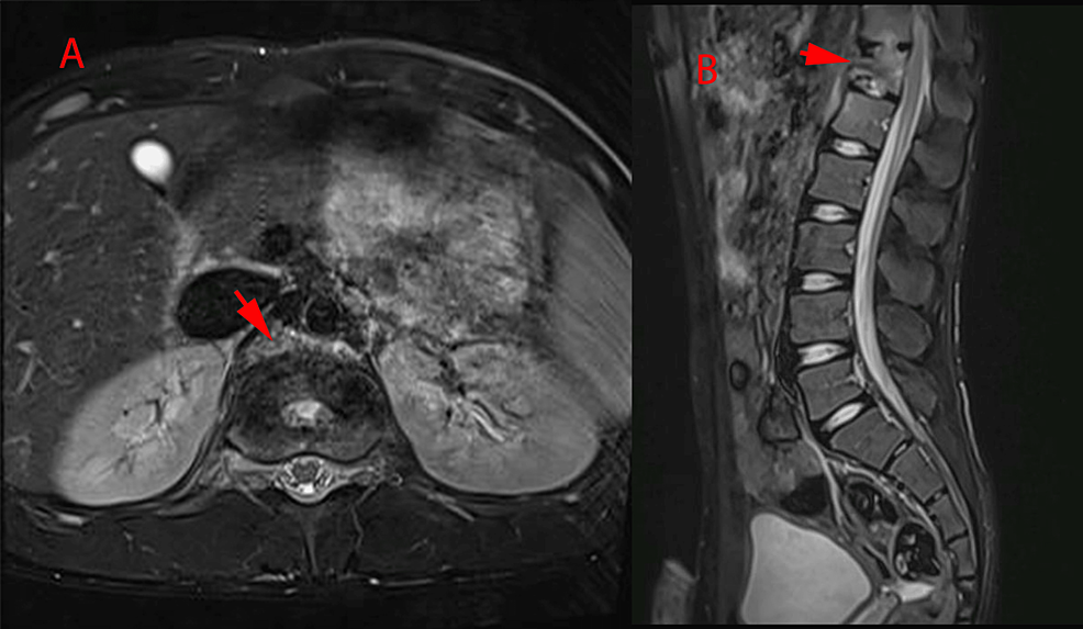 (A)-Axial-and-(B)-sagittal-view-of-T2-weighted-image-of-thoracolumbar-MR-post-completion-of-antibiotics-course.-Red-arrowheads-shows-interval-regression-with-good-response-to-treatment-that-shows-the-process-of-healing-involving-the-T12-vertebra-in-the-form-of-sclerotic-changes,-interval-regression-in-the-disc-collection-involving-T11-12-and-the-anterior-sub-ligamental-collection-at-the-level-T12-and-L1.-Complete-resolution-of-the-retroperitoneal-collection-seen.