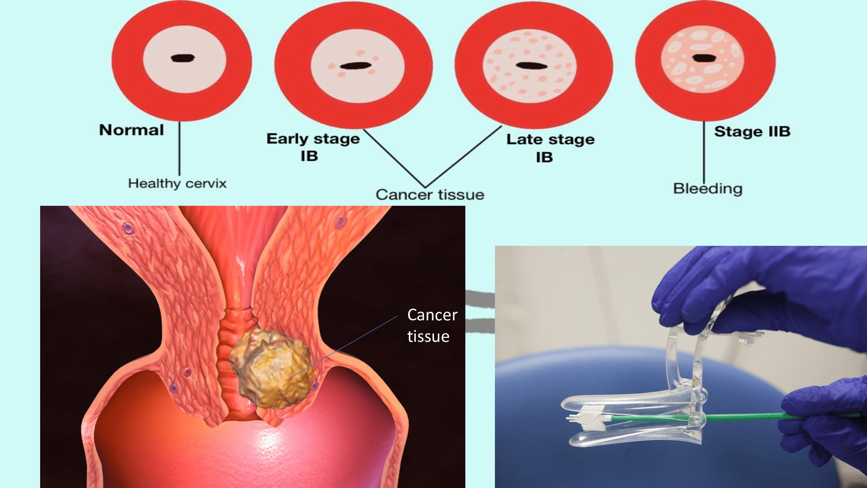 | Cervical Cancer: Detection and Prevention in Reproductive Group | Article