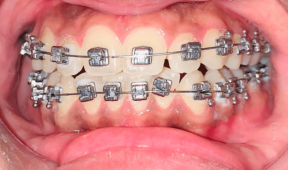 Cureus A Review on Orthodontic Brackets and Their Application in