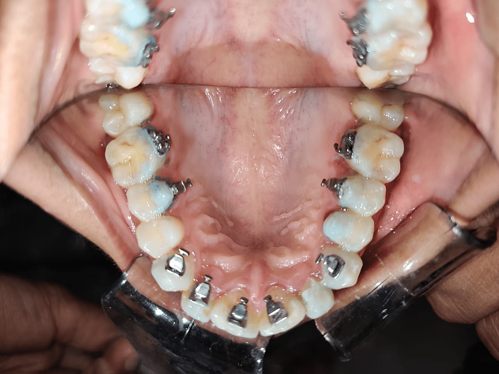 Cureus A Review on Orthodontic Brackets and Their Application in