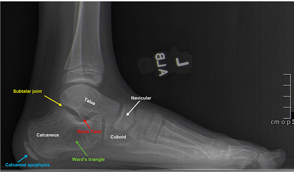 Managing the patient with heel pain | British Journal of Hospital Medicine