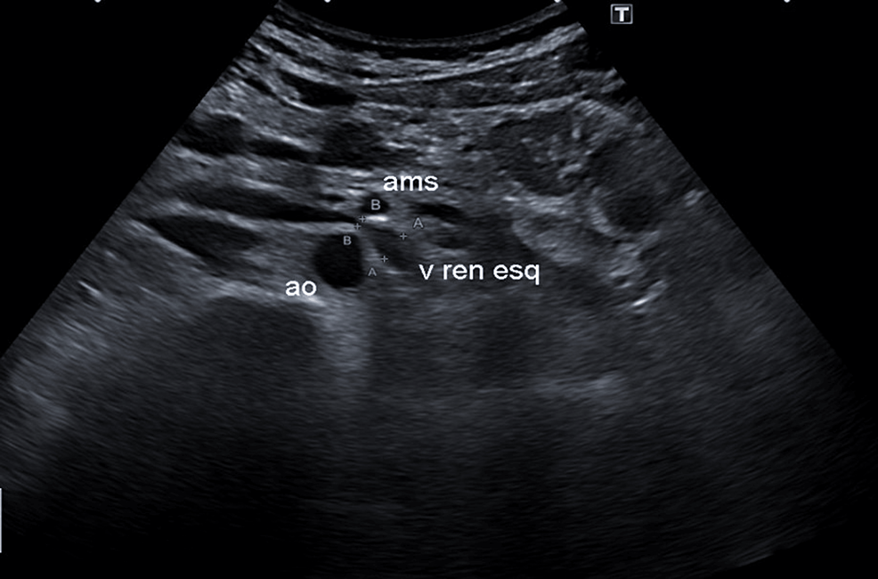 Cureus Nutcracker Syndrome A Cause of Hematuria and Low Back Pain in Young Patients