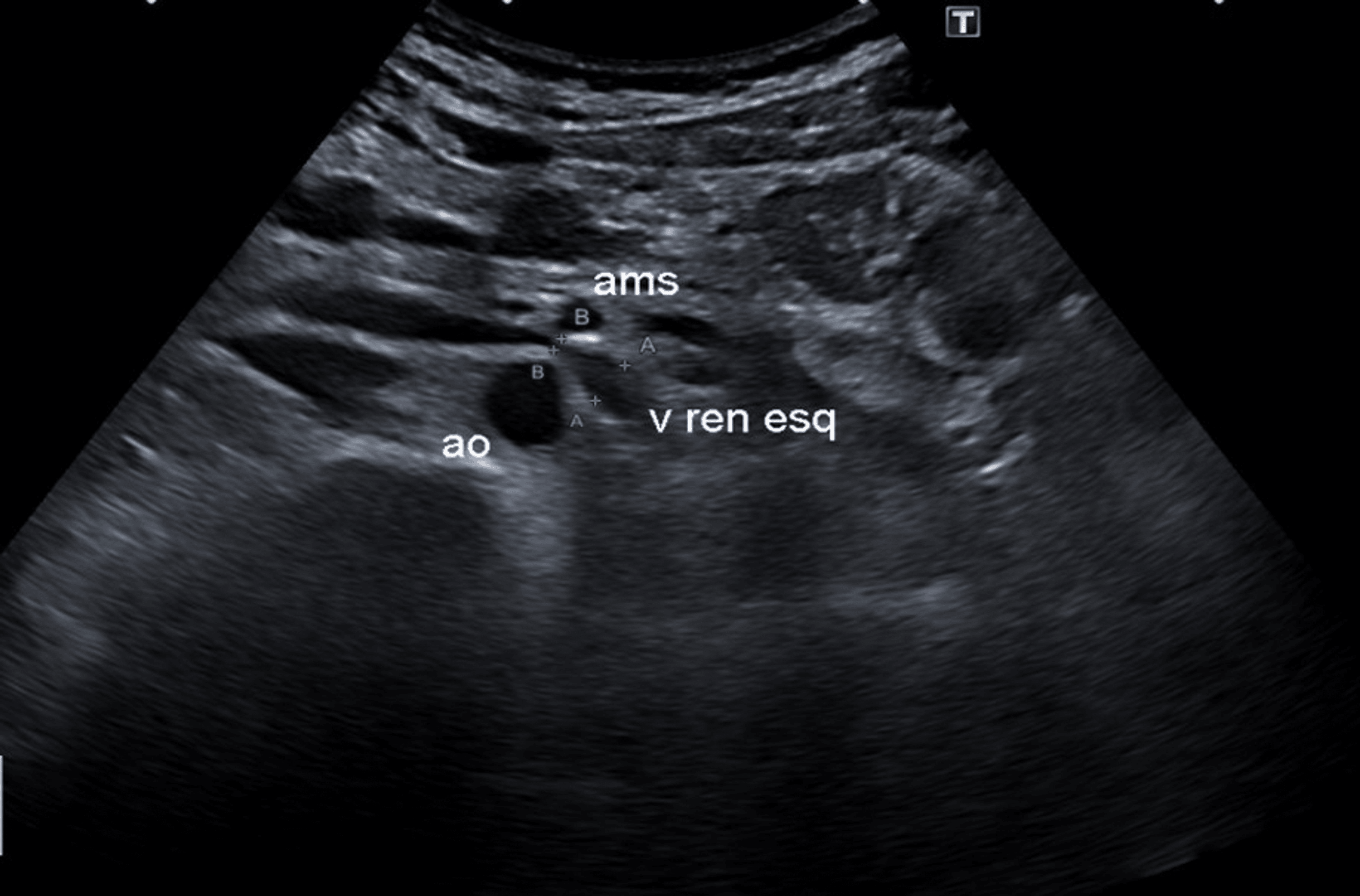 Nutcracker Syndrome A Cause of Hematuria and Low Back Pain in Young