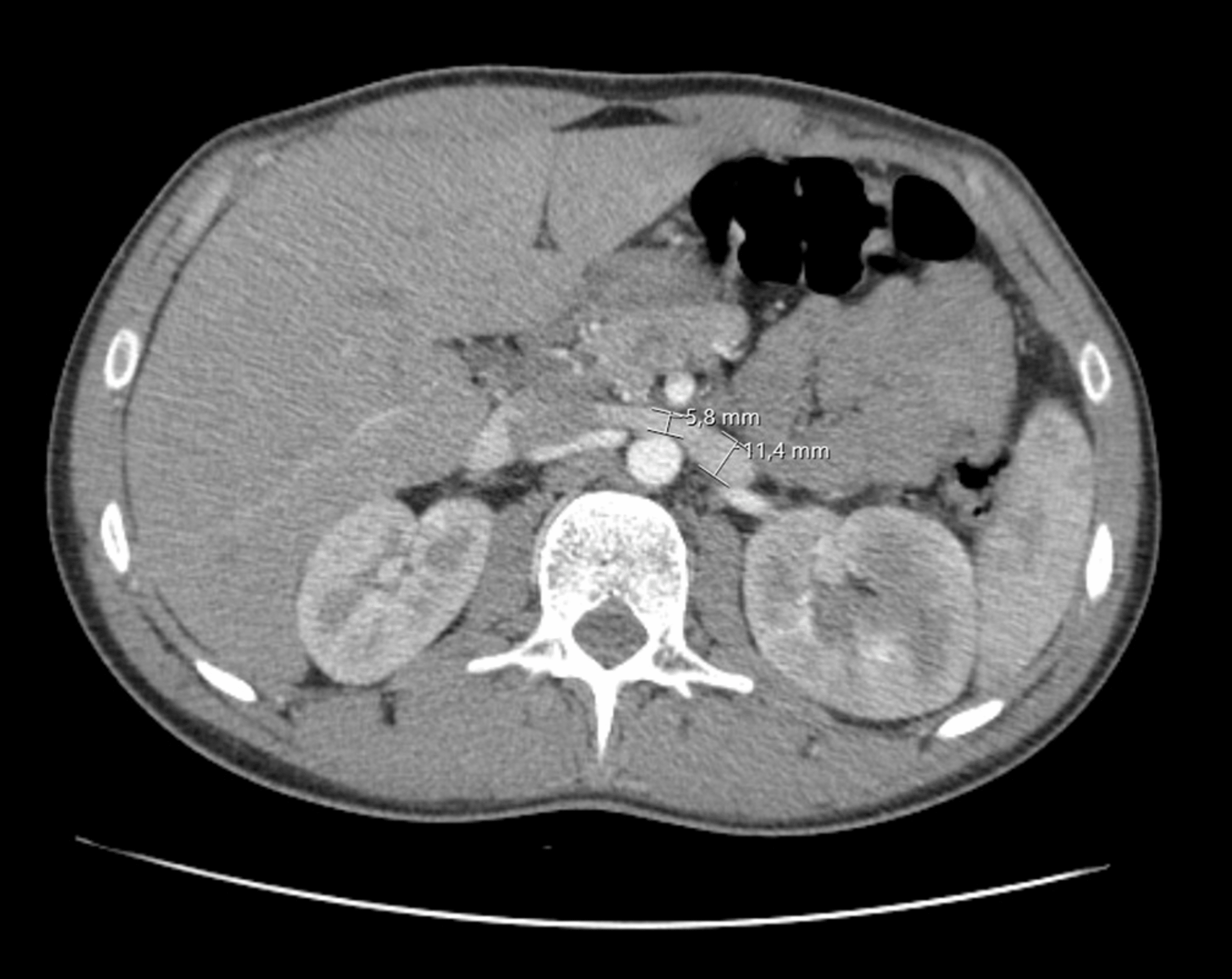 Nutcracker Syndrome A Cause of Hematuria and Low Back Pain in Young