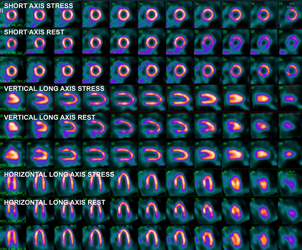 Negative Stress Test Is Not Always Negative Revisiting The Clinical 