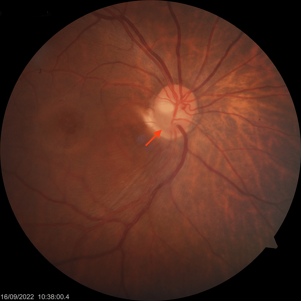 Cureus A Classical Presentation Of Optic Disc Pits With Complex 