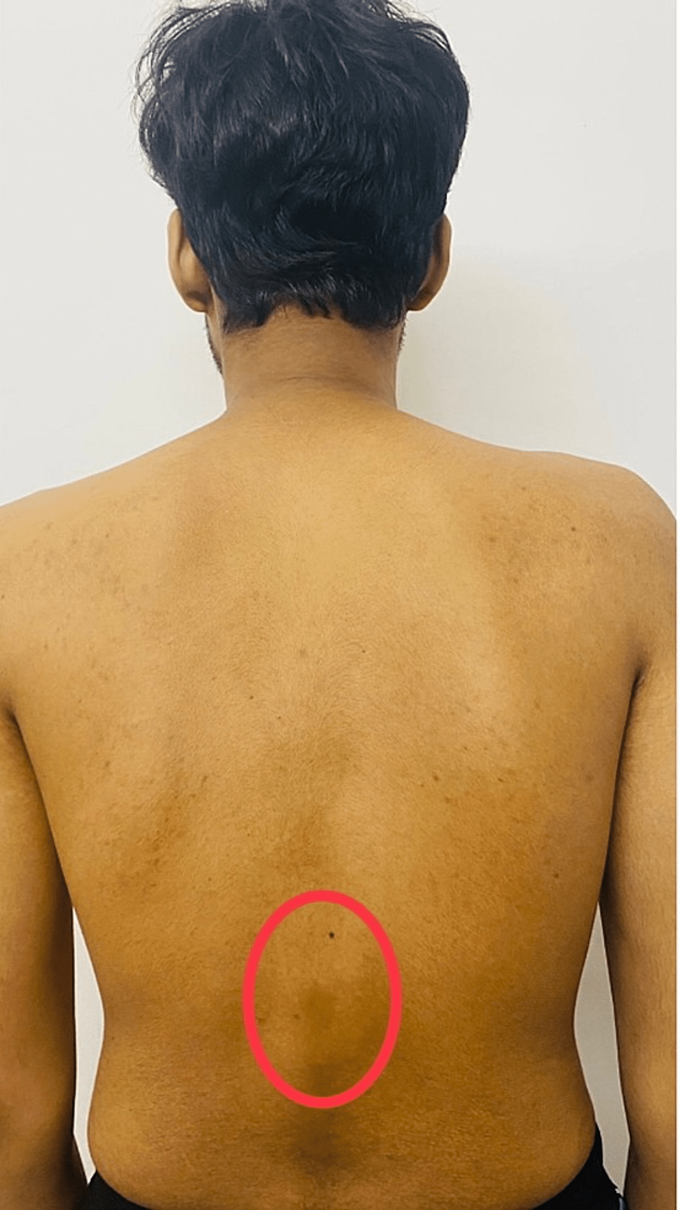 The-image-showcases-the-kyphotic-deformity-in-the-back