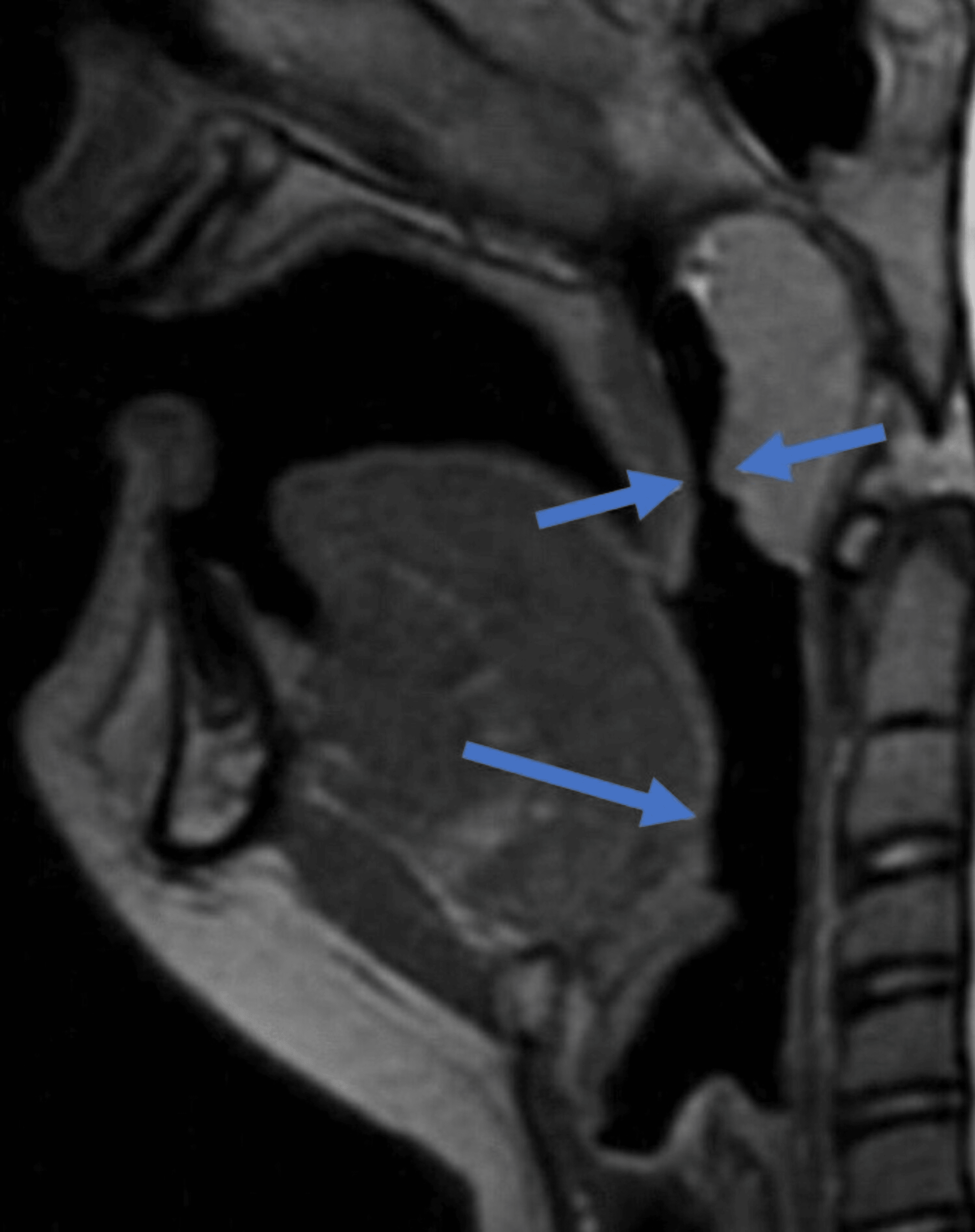 Uvula Infection Mri