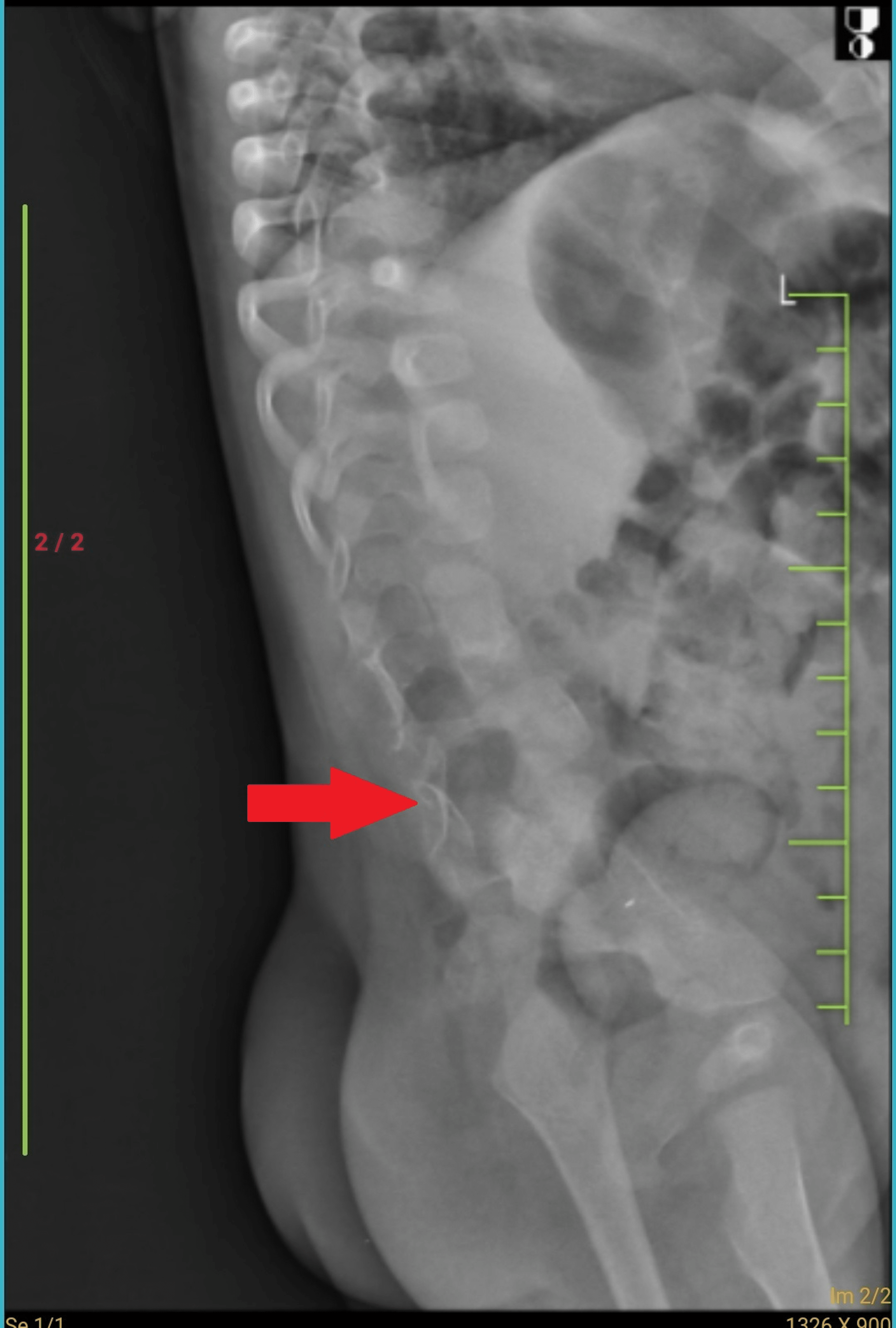 Cureus | An Incidental Finding of Butterfly Vertebrae in a Case of