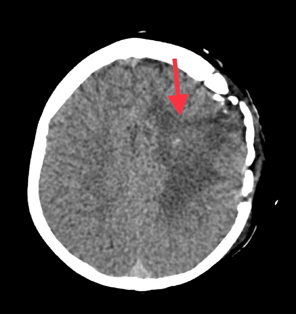 cureus-recurrent-brain-abscess-in-a-child-with-cyanotic-congenital