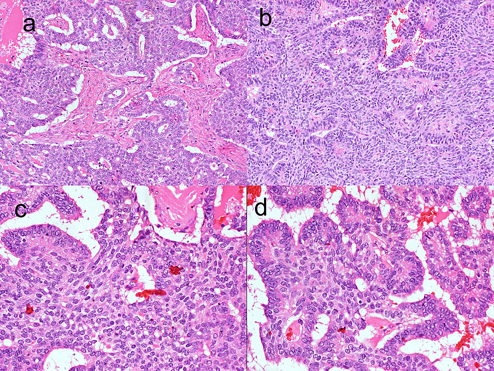 Spindle Epithelial Tumor With ThymusLike Differentiation (SETTLE
