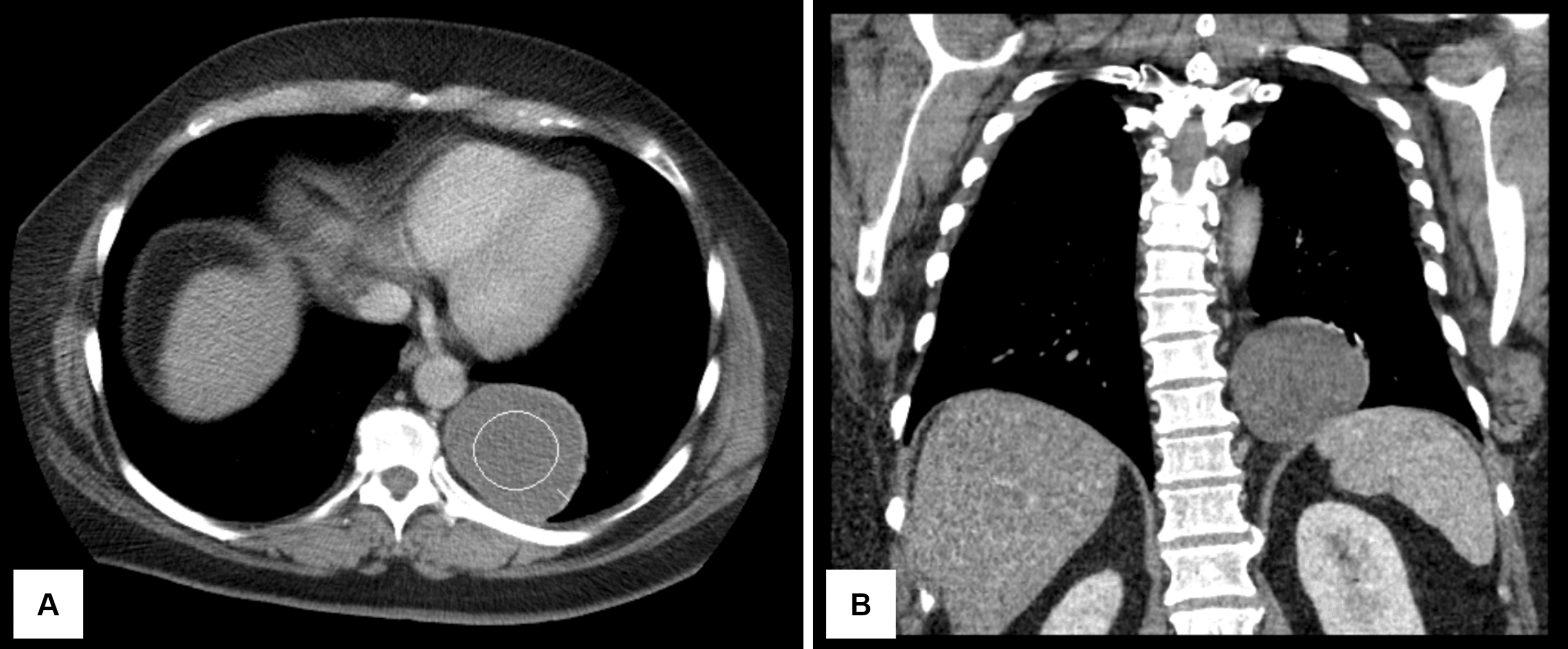 Cureus | Posterior Mediastinal Mass: An Uncommon Presentation of a  Branchial Cleft Cyst